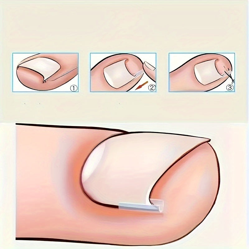 ingrown toenail   20 30   50   70 80 90 100pcs